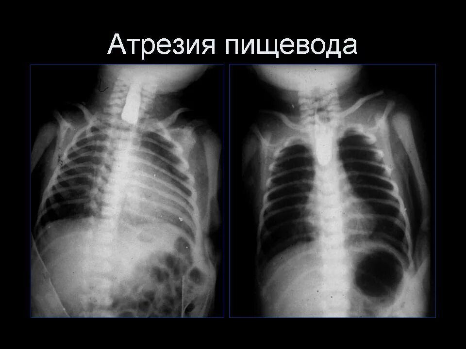 Трахеопищеводный свищ рентген. Атрезия пищевода рентген. Атрезия пищевода у детей рентген. Рентген при атрезии пищевода. Пищевод у новорожденного