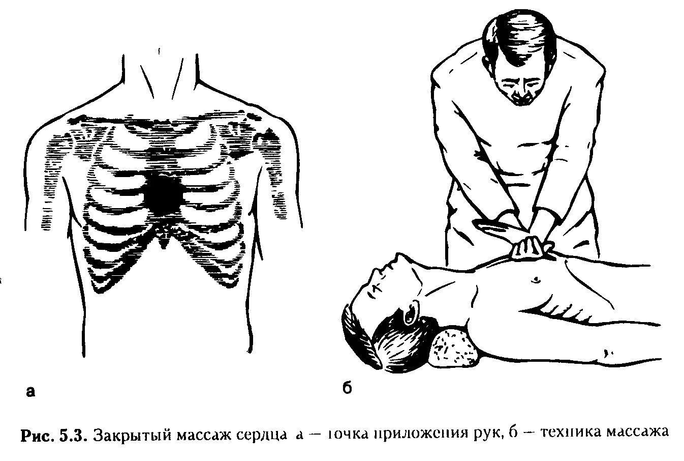 Закрытого (непрямого) массажа сердца. Точка для непрямого массажа сердца. Техника выполнения закрытого массажа сердца. Непрямой массаж сердца техника выполнения. Компрессия грудной клетки при непрямом массаже сердца