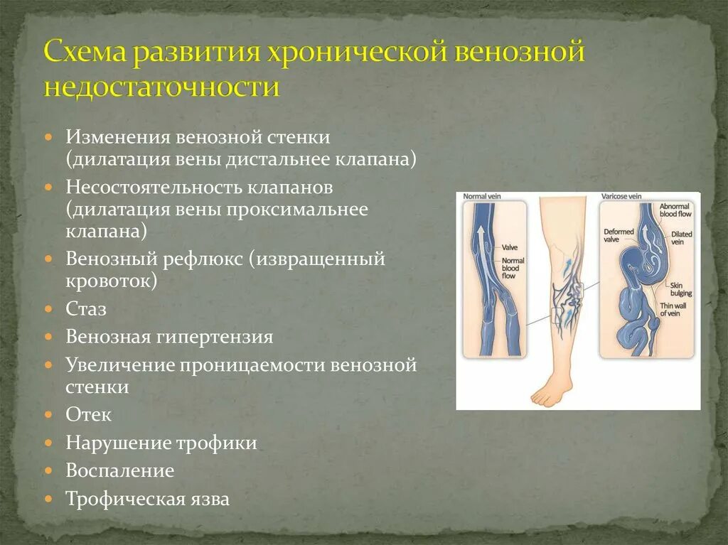 Развитие нижней конечности. Схема развития хронической венозной недостаточности. Варикоз нижних конечностей ХВН 2ст. Хроническая венозная недостаточность классификация. ХВН классификация варикозной болезни.