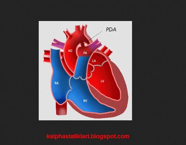 Plexus arteriosus. Дуктус зависимые пороки сердца. дуктус зависимые пороки сердца у новорожденных. patent ductus arteriosus. дуктус зависимая гемодинамика.