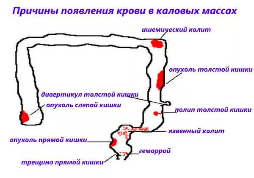 Кровь при дефекации у мужчин причины