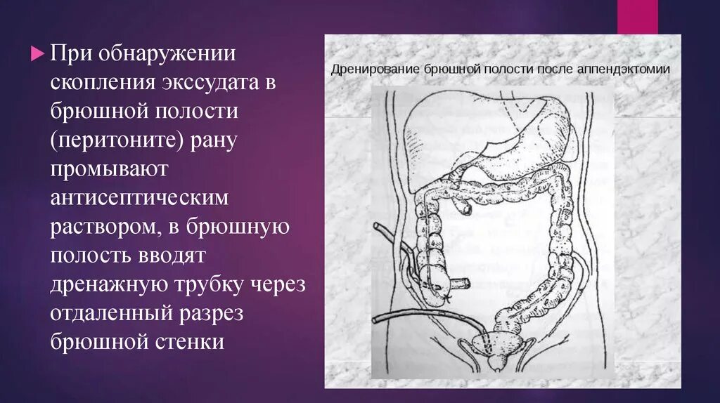 После аппендицита держится температура. Перитонит дренирование брюшной полости. Схема дренирования брюшной полости при перитоните. Аппендэктомия дренирование брюшной полости. Дренирование брюшной полости после аппендэктомии.