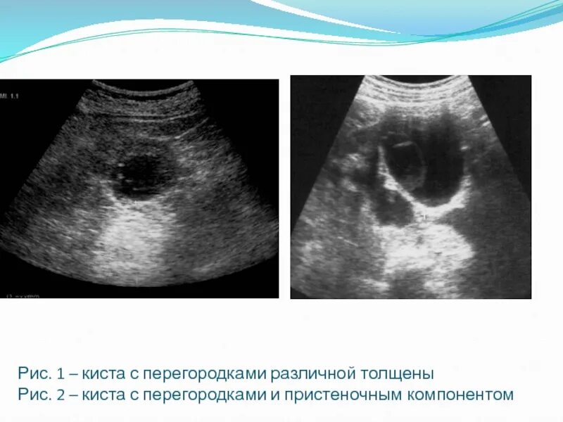 Киста яичника с перегородками. Киста с перегородкой на яичнике. Киста с перегородкой на УЗИ.