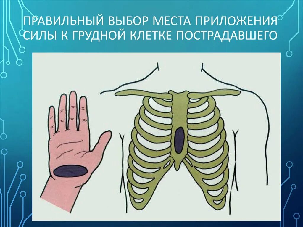 При непрямом массаже сердца пальцы располагаются. Правильное наложение рук при непрямом массаже сердца. место нажатия на грудину при непрямом. положение рук при компрессиях;. непрямой массаж сердца презентация.