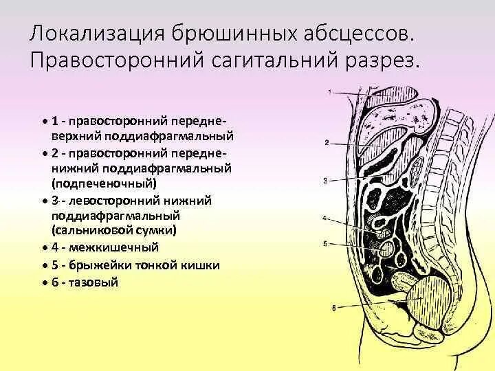 Инфильтрат брюшной полости. Абсцесс брюшной полости. Типичные места локализации абсцессов в брюшной полости. Абсцессы брюшной полости и забрюшинного пространства.