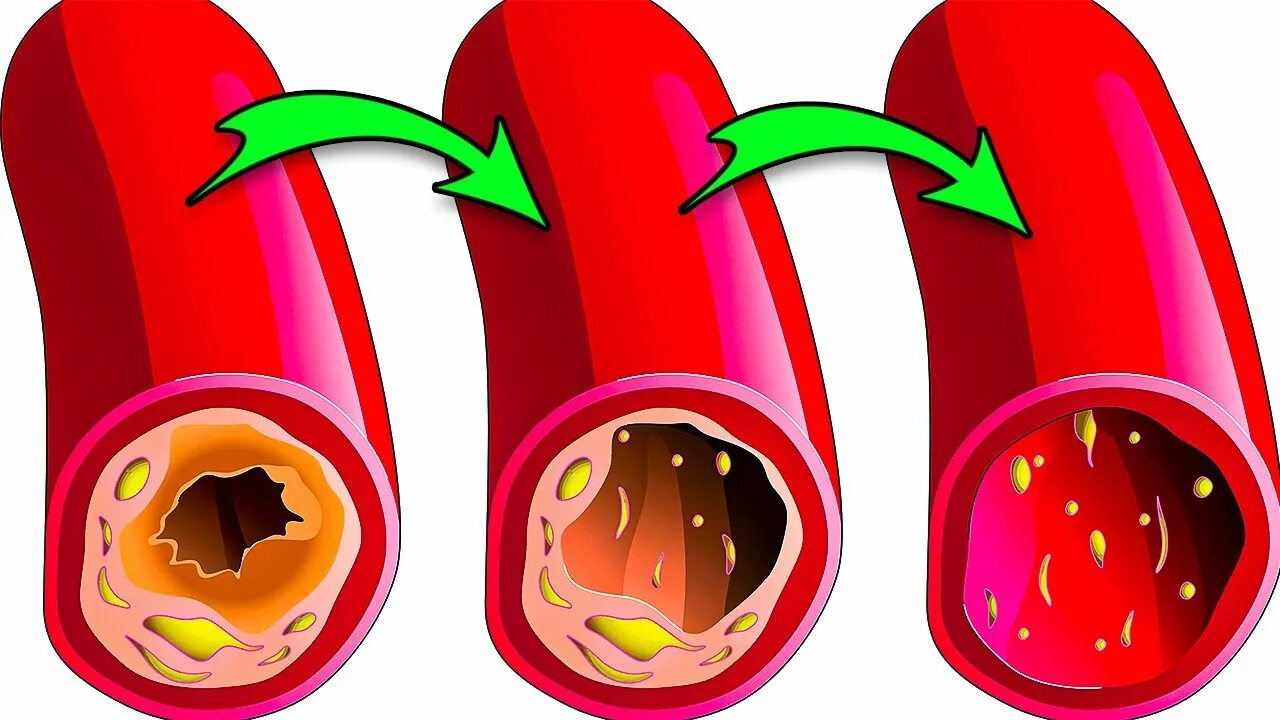 Очистка сосудов от бляшек. Холестерин рисунок. Чистка сосудов от бляшек в сосудах.