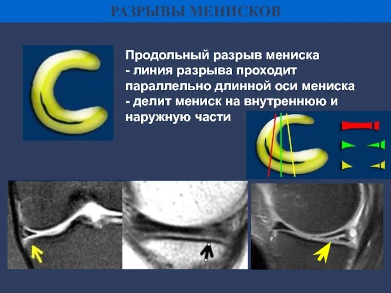 Мениск 3 степени. Разрыв мениска 3 стадии. разрыв медиального мениска 3 степени. разрыв внутреннего мениска 3 степени. горизонтальный разрыв мениска 3 степени.