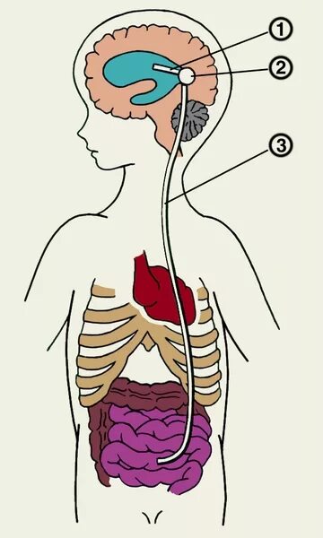 Шунтирование желудочков мозга. Вентрикулоперитонеальный шунт схема. Шунтирование спинномозговой жидкости. Шунтирование мозга в брюшную полость. Как выглядит шунт