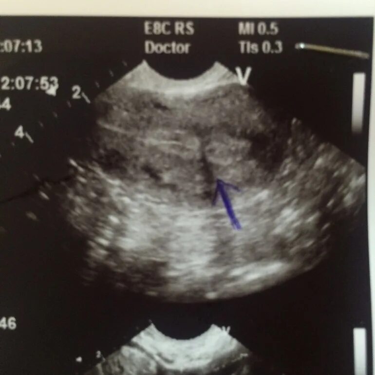 синехии синдром ашермана. синехии в полости матки на узи. синехии в полости матки на узи. внутриматочные синехии на узи что это такое. внутриматочные синехии на узи что это такое.