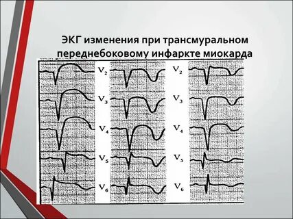 Трансмуральный экг