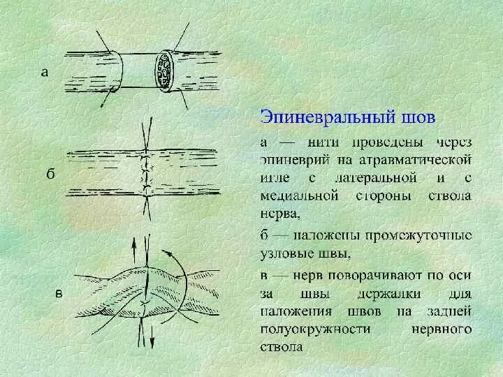 Операции на нервах и сухожилиях