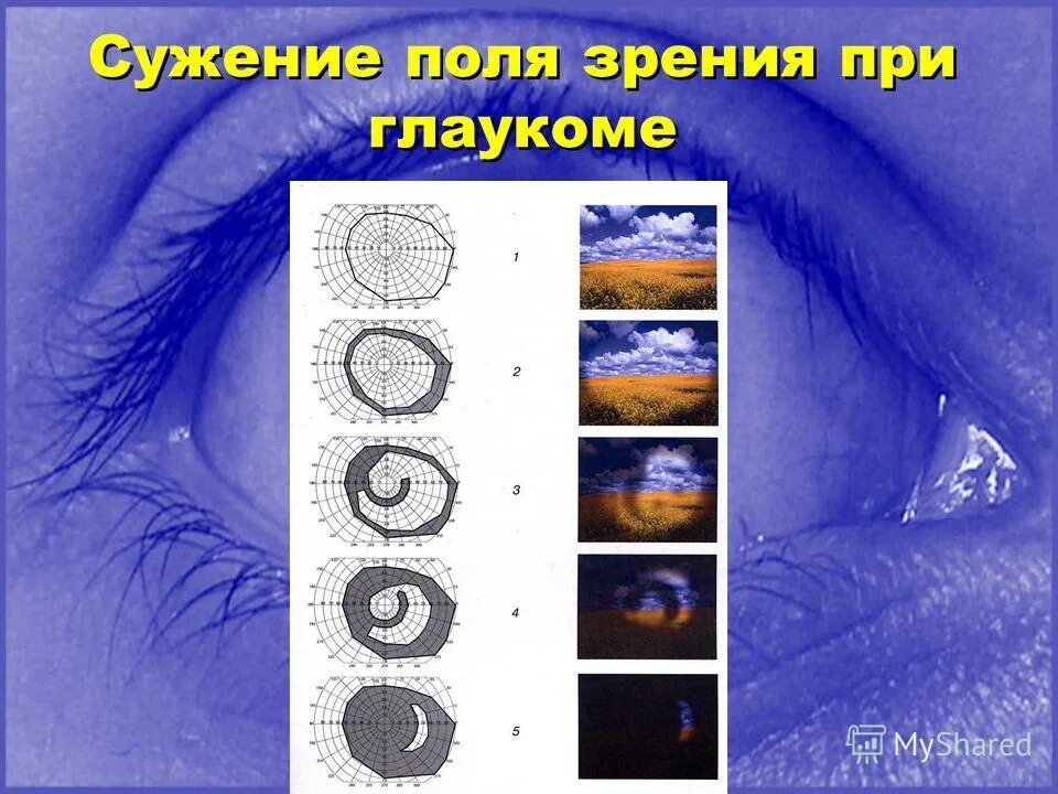 Первичная закрытоугольная глаукома этиология. Глаукома третьей степени. Вероятность рождения больного ребенка. Классификация первичной открытоугольной глаукомы. Синдром аксенфельда ригера.