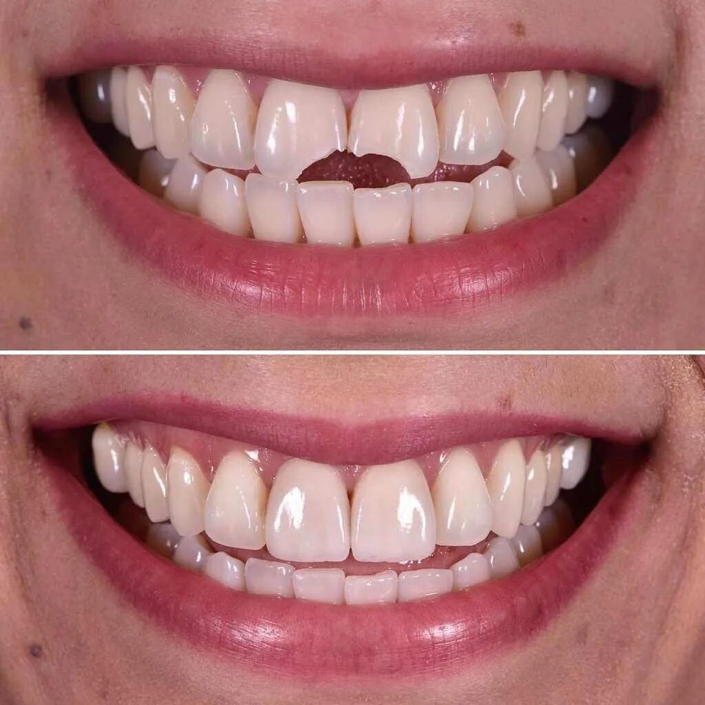 Винир прямой композитный. Композитные виниры улыбка.