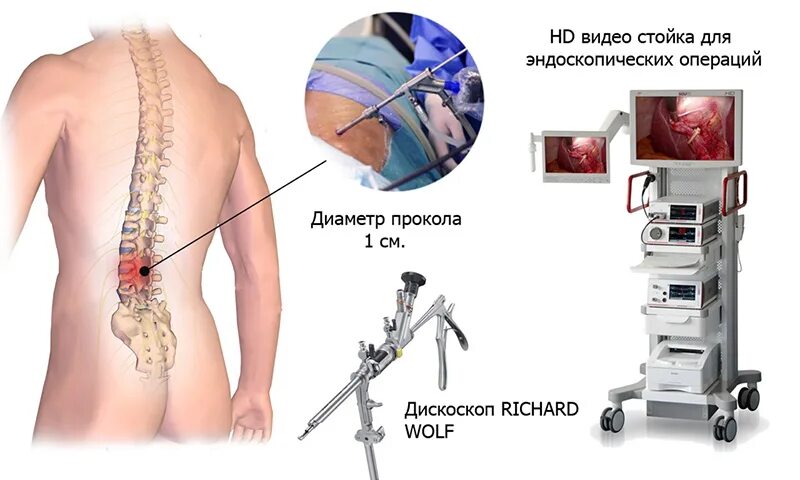 Микродискэктомия грыжи позвоночника. Грыжа позвоночника операция. Операция на поясничном отделе. Операции на позвоночнике поясничного отдела. Сколько реабилитация после операции на позвоночник