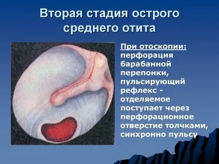 Стадии хронического отита