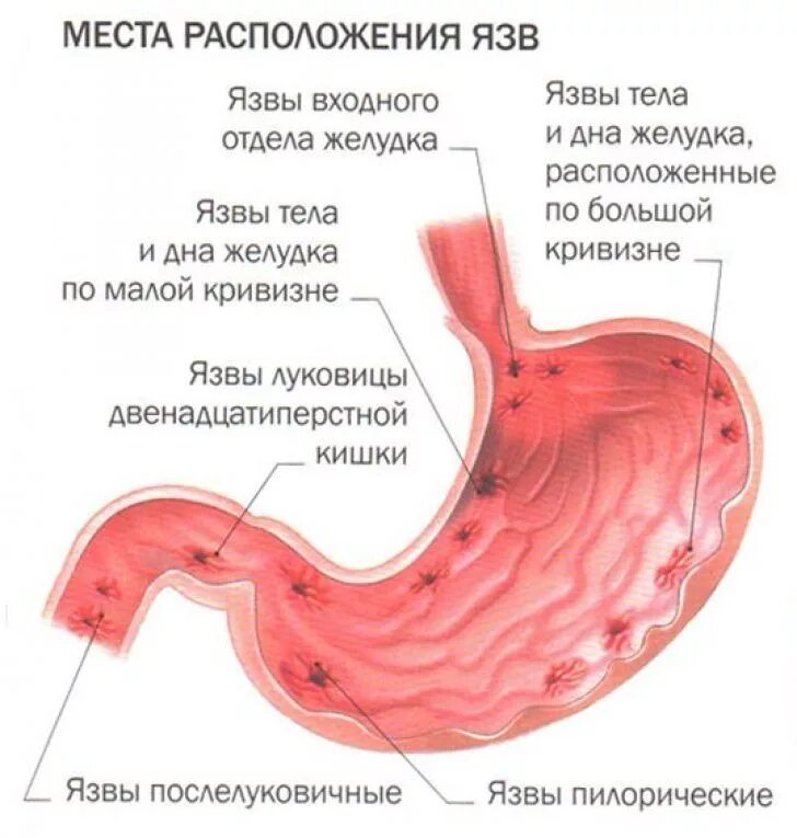 Язвенная болезнь желудка язвенная болезнь 12 перстной кишки. Язвенная болезнь 12 перстной кишки. Язвы 12 перстной кишки располагается. Язва желудка и 12 перстной кишки. Болит живот после кофе