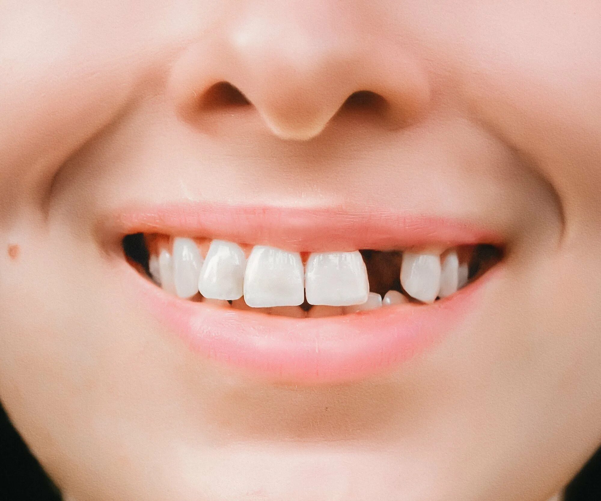 Межзубный пришеечный кариес. Более 1 2 зуба. Более 1 2 зуба. Более 1 2 зуба. Зубы подростка.