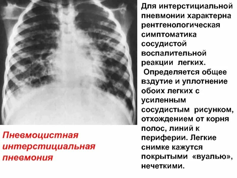 Легочный рисунок усилен корни уплотнены. Корень легкого на рентгенограмме. Корень легкого на рентгенограмме. Пневмокониоз легких 3 стадии рентген. Дефект межжелудочковой перегородки на рентгенограмме.