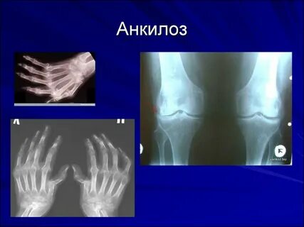 Анкилоз