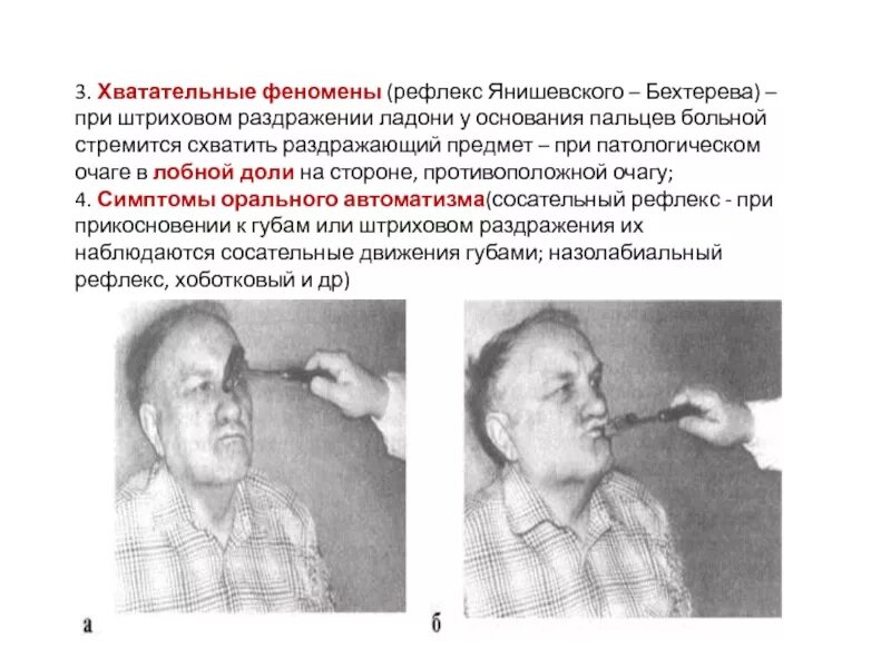 Феномены мозга бехтерева. Симптом янишевского. патологический хоботковый рефлекс. патологический хватательный рефлекс янишевского. хоботковый рефлекс бехтерева.