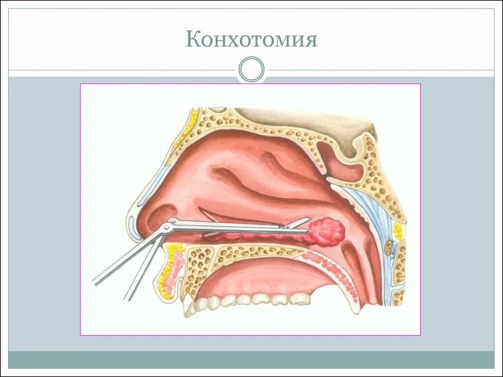 Атрофический ринит симптомы и лечение