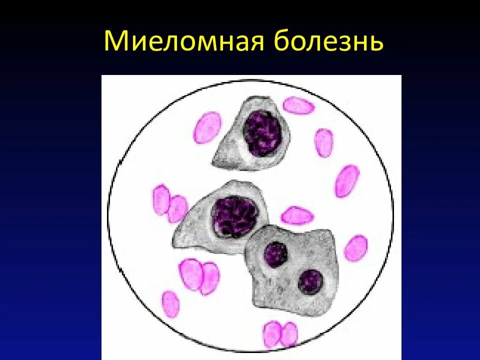 Миеломная болезнь что. Формы миеломной болезни. Миеломная болезнь патоморфология. Кость при миеломной болезни патанатомия.