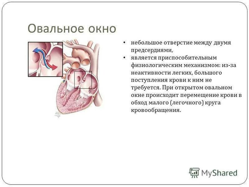 Где находится овальное окно. Овальное отверстие в сердце плода. Функционирующее открытое овальное окно у новорожденных. Овальное окно в сердце 3.8 мм у новорожденного. Врожденный порок сердца открытое овальное окно.