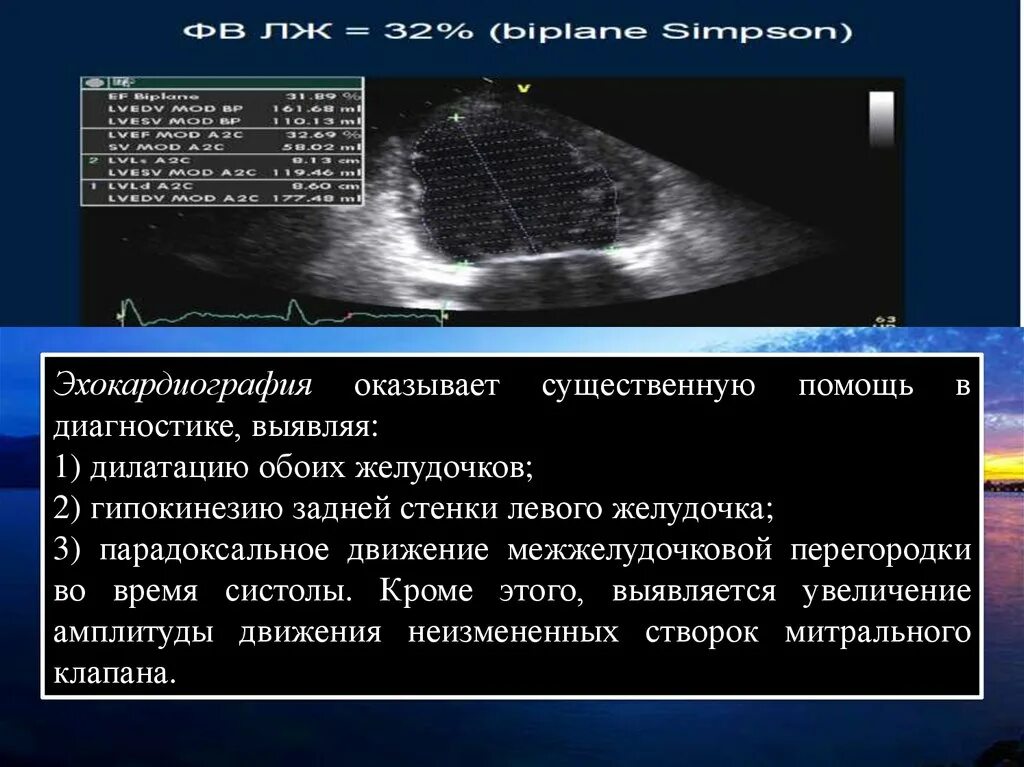 Гипокинез стенки левого желудочка. Сегменты миокарда левого желудочка схема. Эхокардиография сердца. Гипокинез верхушки левого желудочка. Эхокг при инфекционном эндокардите.