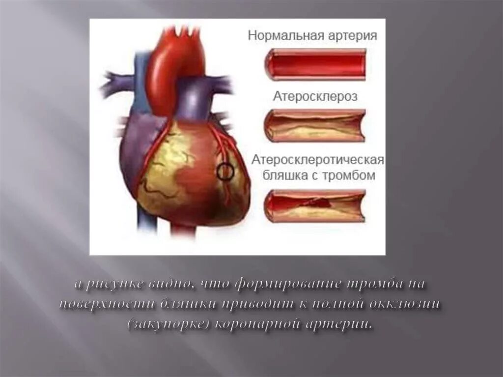 Закупорка коронарной артерии. Непроходимость коронарных сосудов. Окклюзия коронарных сосудов. Сердце коронарные сосуды окклюзия. Тромб и бляшка разница