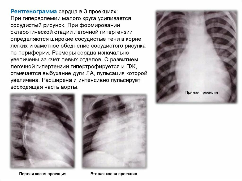 Что значит на рентгене расширена тень сердца. Описание сердца на рентгенограмме. тень сердца расширена на рентгене. рентгеноскопия сердца.