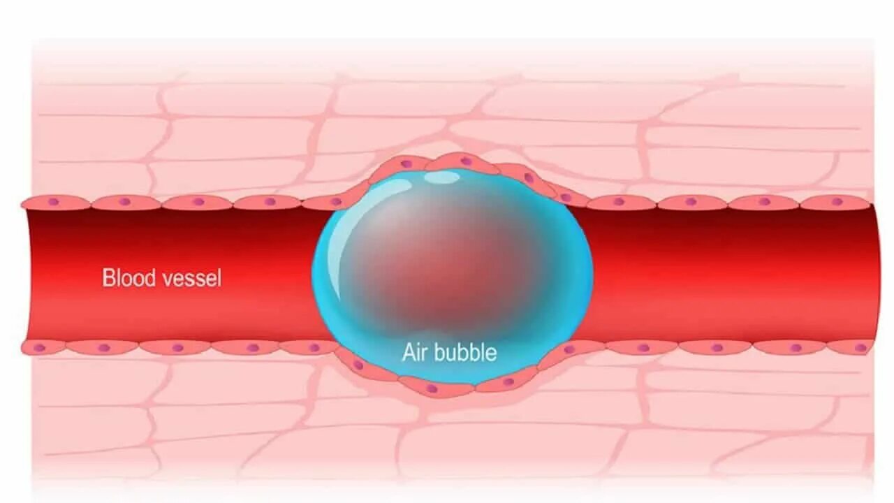 Пузырьки кислорода в крови. Кессонная болезнь воздушная эмболия. Воздушная эмболия сосудов. Эмболия пузырьками воздуха. Венозная газовая эмболия.