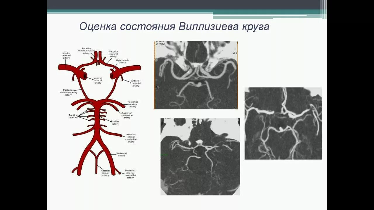 Сегменты артерий Виллизиева круга. Сегменты Виллизиева круга мрт. Виллизиев круг анатомия на кт. Виллизиев круг мрт.