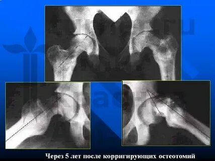 Юношеский эпифизеолиз головки