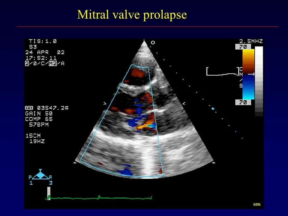 Что такое пролапс митрального клапана. Пролапс митрального клапана УЗИ. Отрыв хорды митрального клапана ЭХОКГ. Пролапс митрального клапана Эхо степени. Пролапс митрального клапана 1 ст.