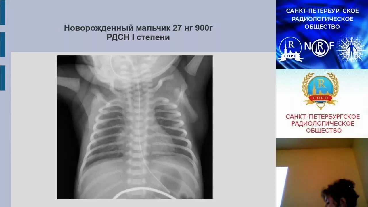 Респираторный дистресс новорожденных. РДС синдром новорожденных рентген. Респираторный дистресс синдром новорожденных рентген. Рентген при респираторном дистресс синдроме. Рентгенограмма новорожденного при РДС.