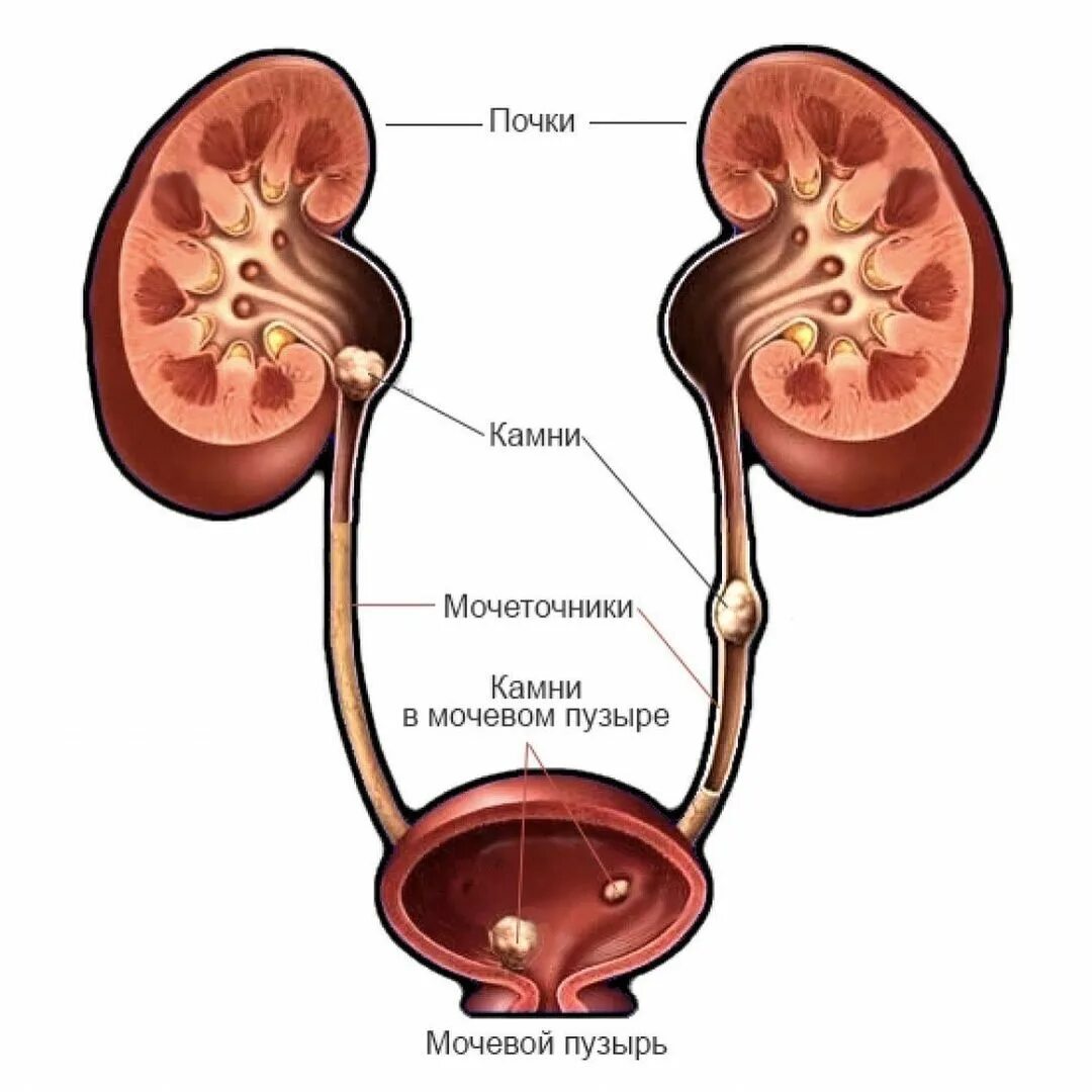 мочеточник 4 мм. строение почки и мочеточника. (мочевой пузырь) конкремент в устье мочеточника. мочеточник 4 мм. мочеточники анатомия человека.