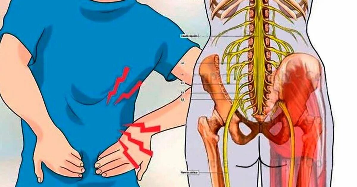 Боль в спине защемление нерва. Невралгия седалищного нерва рентген. Защемлкние седалищного нервв. Сидалеч седалищный нерв. Воспале5иеиседалищного нерва.