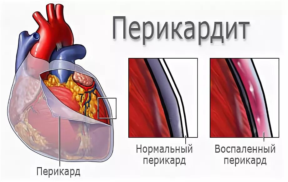 Скопление воздуха и крови в перикарде. Перикард сердца заболевания.