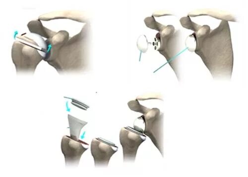 Операция по замене плечевого сустава. Эндопротез плечевого сустава Тотальный реверсивный. Эндопротез ревизионный плечевого сустава. Эндопротезирование плеча. Эндопротез головки плечевой кости.