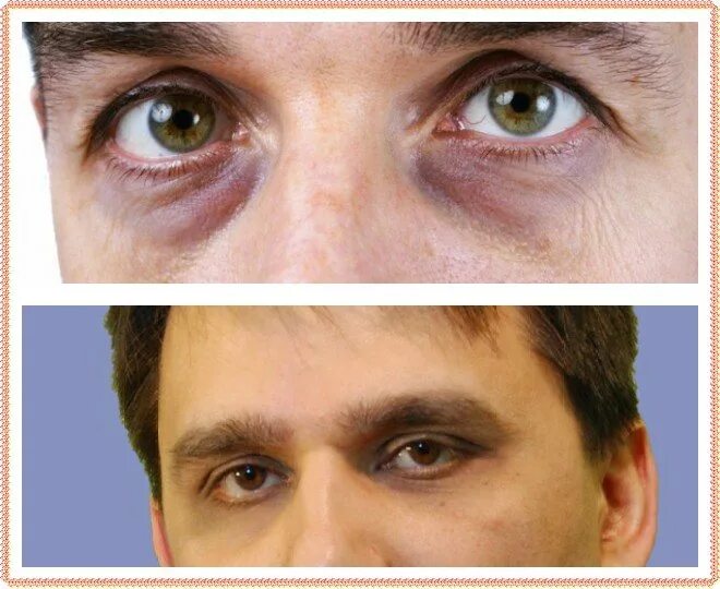 От чего под глазами у мужчин