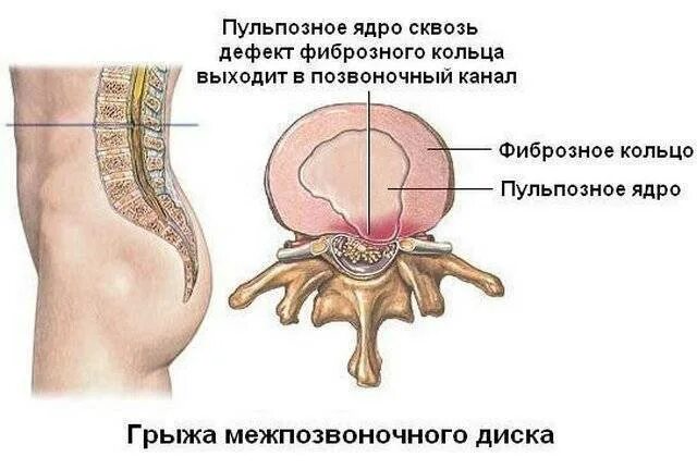 Как лечить межпозвоночную грыжу поясничного. Грыжи дисков поясничного отдела позвоночника. межпозвоночная грыжа поясничного отдела симптомы. межпозвоночная грыжа пульпозное ядро. грыжа позвоночника поясничного крестцового отдела позвоночника.