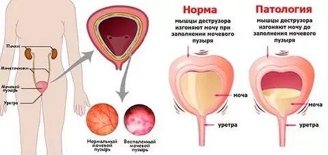 Высокое давление мочеиспускание
