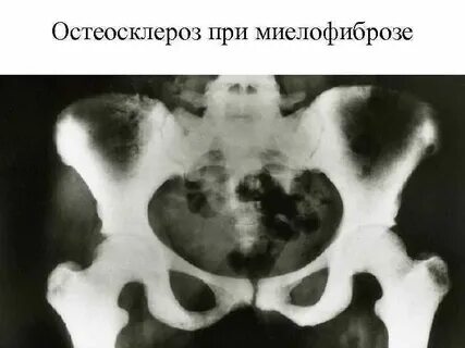 Очаг остеосклероза
