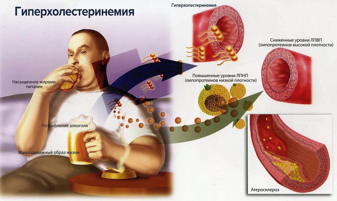 Лишний холестерин. Атеросклероз сосудов факторы риска. Атеросклероз и дислипидемия. Дислипидемия фактор риска атеросклероза. Гиперхолестеринемия.