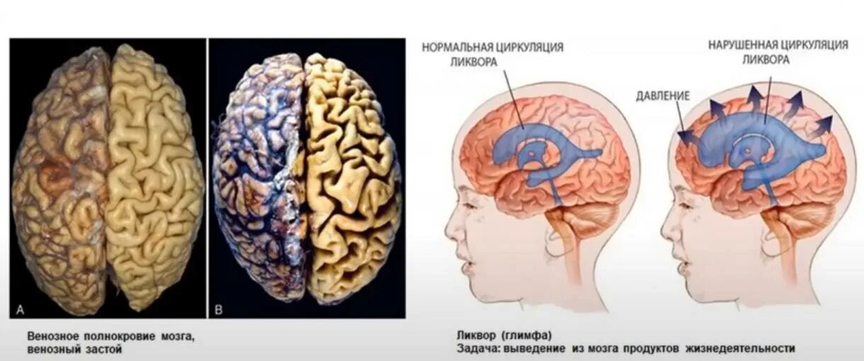 Проявление внутричерепного давления. Кт головного мозга повышенное внутричерепное давление. Внутреннее черепное давление. Внутричерепное давление у ребенка.