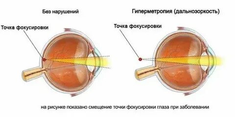 Гиперметропия слабой степени мкб