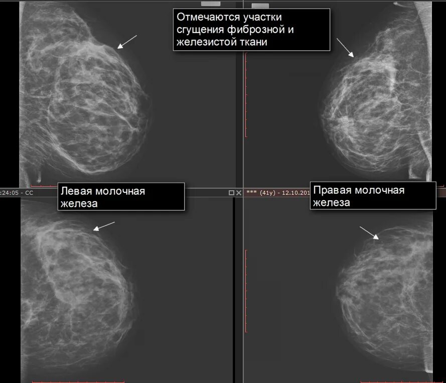 Фиброзно кистозная мастопатия маммограмма. Диффузная кистозная мастопатия на узи. Узи молочных желез фиброаденома узи. Эхопризнаки молочной железы. Эхопризнаки молочной железы.