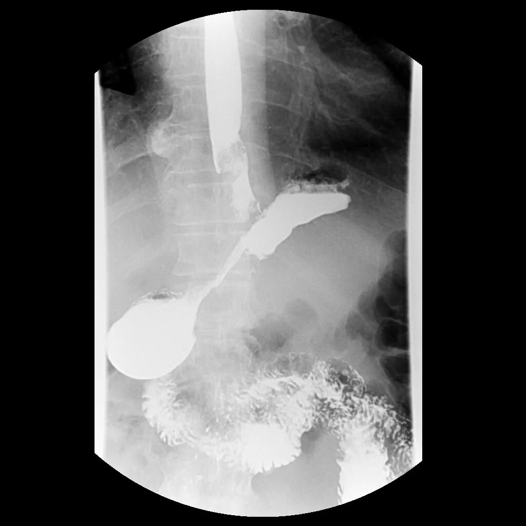 Пептическая язва пищевода рентген. Прободная язва желудка рентген с барием. Язва малой кривизны желудка рентген.