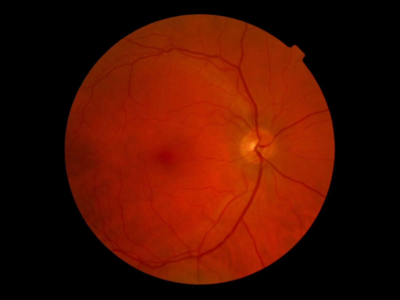 Диабетическая ретинопатия неоваскуляризация. Диабетическая ретинопатия офтальмоскопия. Пролиферативная ретинопатия. Диабетическая ретинопатия глазное дно. Тест сетчатки глаза