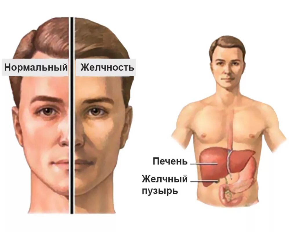 Печень синдром жильбера. Интермиттирующая желтуха.